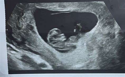 10 Wk Ultrasound ️ Babycenter