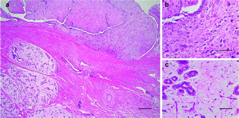 Histologic Features Of A Phyllodes Tumor Pt With Myxoid Fibroadenoma