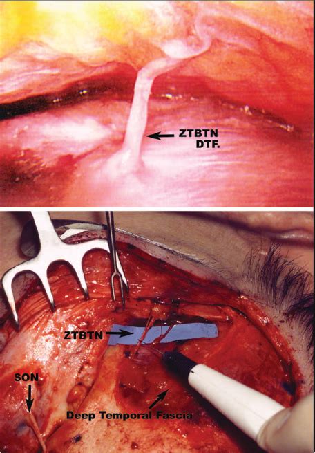 Surgical Treatment Of Temporal Migraine Headaches Site Ii Plastic