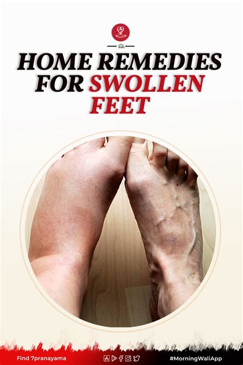 10 Best Home Remedies For Swollen Feet You Should Try In 2021 Home