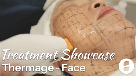Thermage Face Skin Tightening Treatment Showcase Youtube