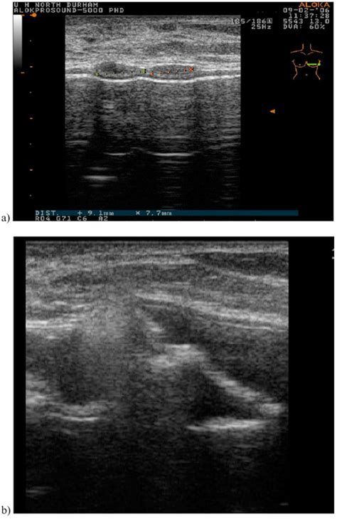 Ultrasound Of The Left Breast Implant Demonstrates Several Hypoechoic