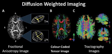 Diffusion Weighted Imaging Refers To A Set Of Magnetic Resonance