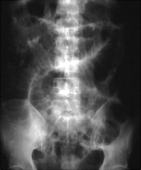 Bowel obstruction (or intestinal obstruction) is a mechanical or functional obstruction of the intestines, preventing the normal transit of the products of digestion. front