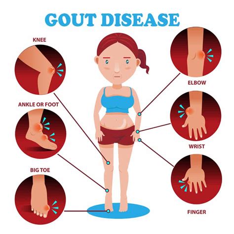 Relieve Gout Symptoms Read More Articlesguidesdoctor Advices