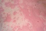 Pictures of Skin Heat Rash Treatment