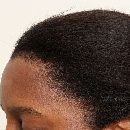 Maybe you would like to learn more about one of these? Black female hair transplant - Female Before And After ...