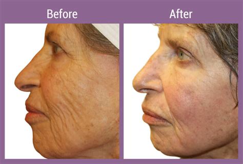 Fraxel Laser Skin Resurfacing Allura Skin Laser And Wellness Clinic