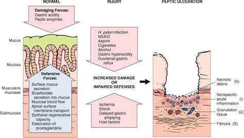 Chronic Gastritispeptic Ulcer Pathogenesis