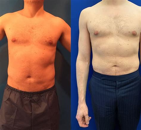 Before After Male Liposuction Results Neinstein Plastic Surgery