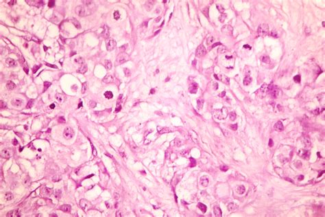 Malignant Nodular Hidradenoma Of Vulval And Perineal Region A Case Report
