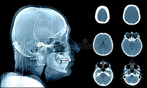 Normal Head On Ct Scans Stock Photo Image 55979524