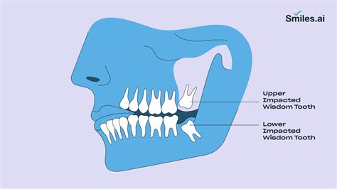Everything You Need To Know About The Wisdom Tooth Extraction