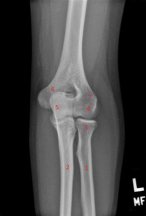 Case 23 Elbow X Ray Ap View Diagram Quizlet