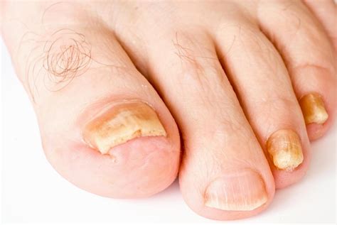 How Should I Treat Toenail Fungus With Pictures