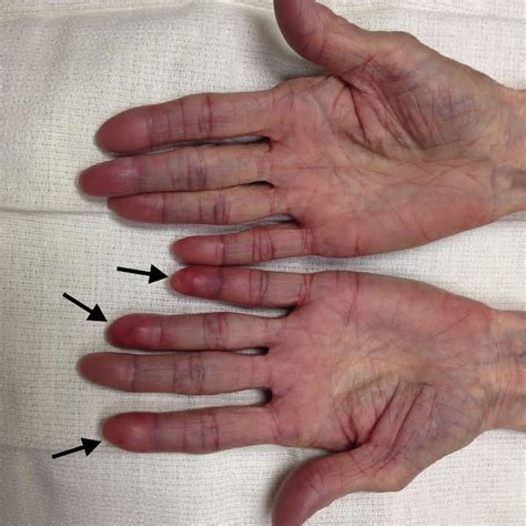 Elderly Woman With Painful Swollen Fingers Annals Of Emergency Medicine