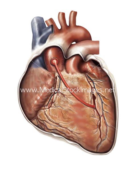 Illustration Showing A Coronary Artery Bypass Graft Or Cabg Medical