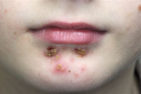 How To Treat Impetigo And Control This Common Skin Infection
