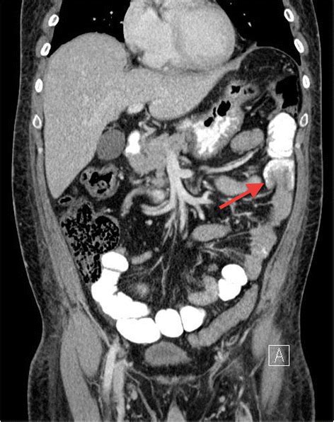 Transient Small Bowel Intussusception In An Adult Case Report With