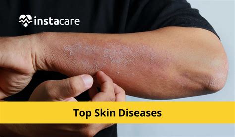 The 10 Most Common Skin Diseases And How To Treat Them