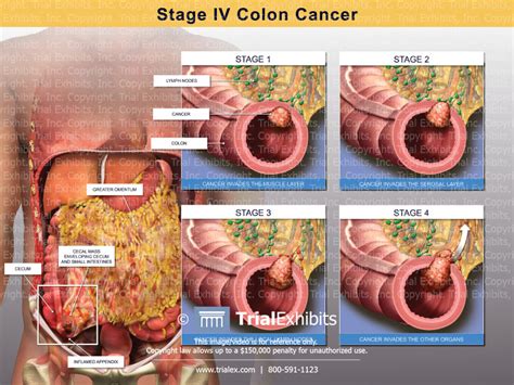 Stage Iv Colon Cancer Trialexhibits Inc