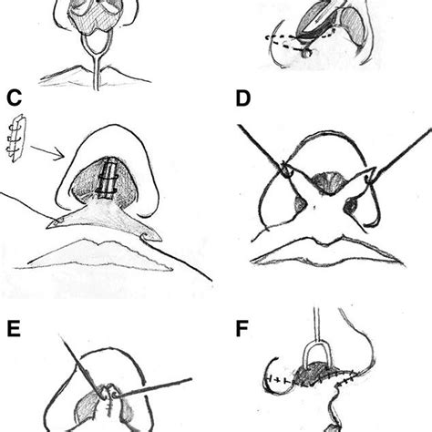 An Ipsilateral Mucoperichondrial Flap Based On The Caudal Septum Was