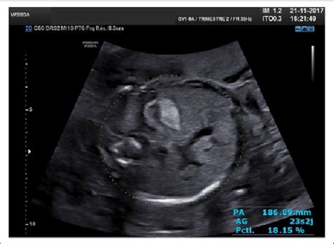 Echogenic Bowel Visualized In 2d Ultrasound Secondary To A Probable