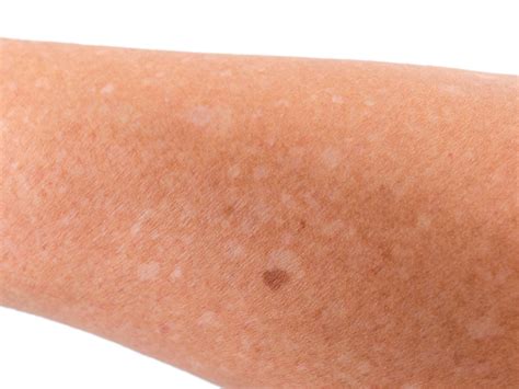 White Spots Can Signal A Vitamin B12 Deficiency First For Women