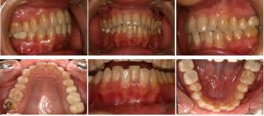 Missing Or Extraction Of A Mandibular Incisor In Orthodontics