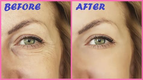 Remove Under Eye Wrinkles And Fine Lines Permanently In 1 Week At Home
