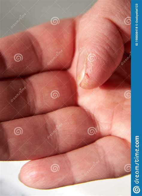 Cracked And Dry Skin On A Woman`s Thumb Close Up Stock Photo Image
