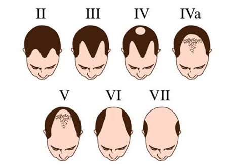 The most common form of hair loss is androgenetic alopecia or male pattern there are 07 hair loss stages in male pattern baldness which are categorized using the norwood. Key Factors responsible for Hair loss in men And women