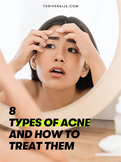 8 Types Of Acne And How To Treat Them Thrivenaija