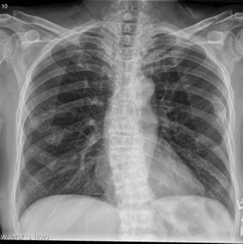 Dinter dj, neff wk, klaus j, böhm c, hastka j, weiss c, et al. Multiple myeloma - extensive | Image | Radiopaedia.org