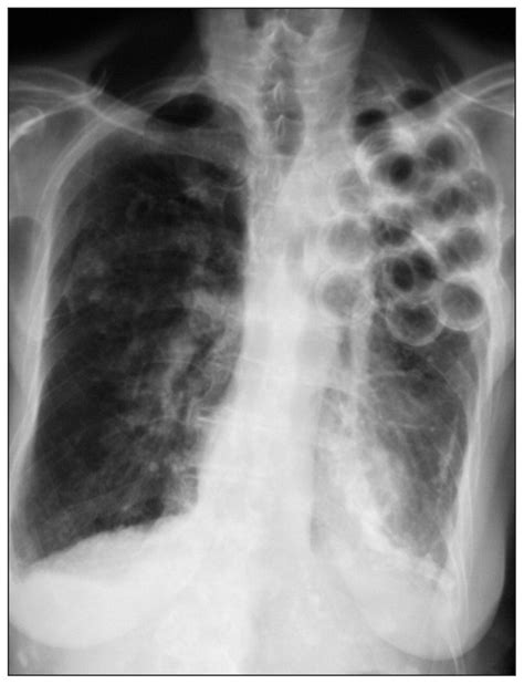 Plombage Old Way Of Treating Pulmonary Tuberculosis Before Akt
