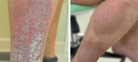 Pictures Of Psoriasis On Legs Symptoms And Pictures
