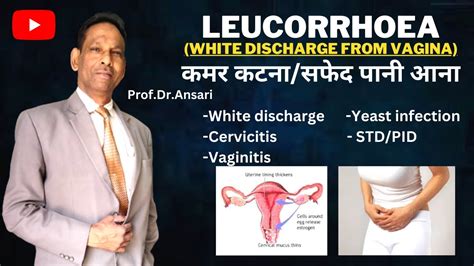 Leucorrhoea कमर कटना White Discharge From Vagina Back Pain Yeast