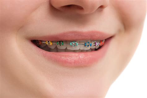 closeup multicolored braces on teeth beautiful female smile with self ligating braces