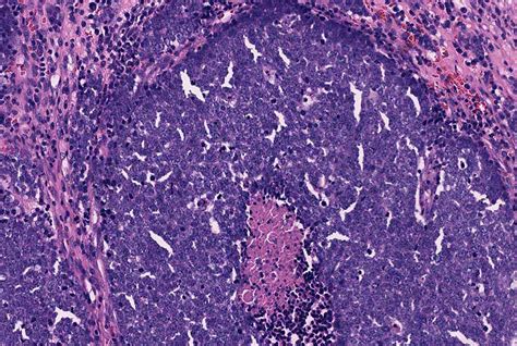 6a Merkel Cell Carcinoma Vulva Central Necrosis Mages Flickr