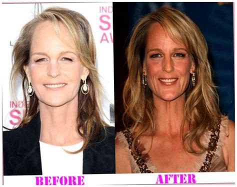 Helen Hunt Plastic Surgery Before And After Photos Celebrity Plastic Surgery News Before And