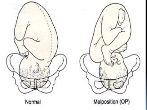 Malposition Of The Fetal Head Ppt Download