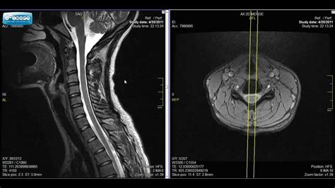 Normal Cervical Spine Mri Explained Dr Jeffrey Pjohnson Hd Youtube