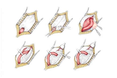 Much will be mentioned about mesh repairs of hernias in the remainder of this chapter, but this section gives a brief overview of mesh and its science. FAQ on Traditional Hernia Repair Surgery with Mesh