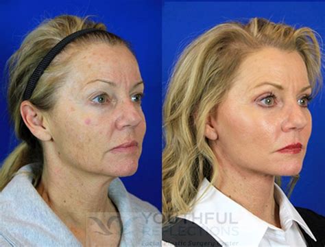 CO Laser Skin Resurfacing Before After Photos Patient Nashville TN Youthful Reflections