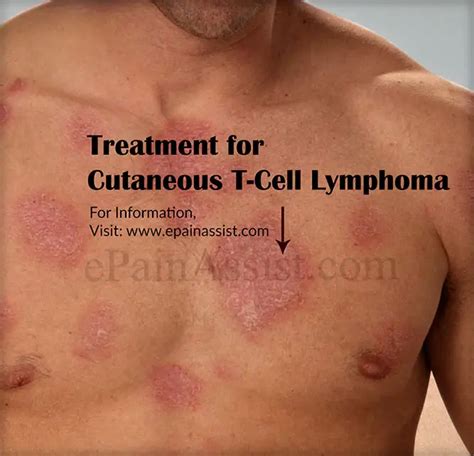 Treatment For Ctcl Or Cutaneous T Cell Lymphoma