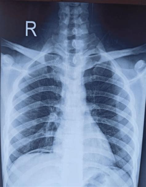 Plain Chest X Ray In Erect Position Showing Crescentic Gas Shadow Below