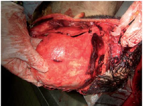 Figure 1 From An Unusual Lethal Gunshot Wound To The Head Semantic