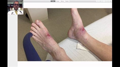 Patient Follow Up Foot Abscess Video Youtube