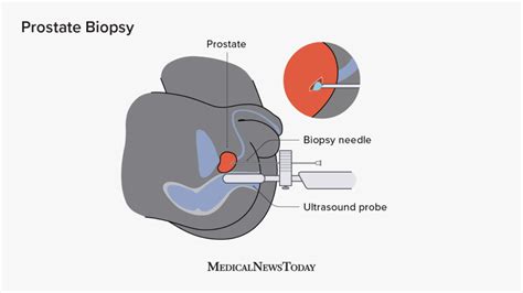 Prostate Biopsy Procedure Preparation Recovery And Results