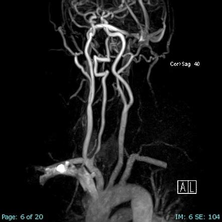 Vertebral Artery Dissection Radiology Case Radiopaedia Org